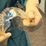 IMSS salva la vida de un joven con prótesis craneal