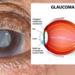 GLAUCOMA