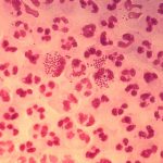 Organización Mundial de la Salud advierte sobre nueva “súper gonorrea”