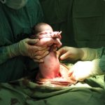 El IMSS reduce número de nacimientos por cesárea