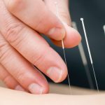 Pacientes con infertilidad buscan ayuda en la acupuntura
