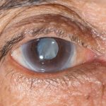 1.5 millones de personas en México afectados por glaucoma