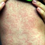 Detectan 4 casos de sarampión en México; descartan epidemia