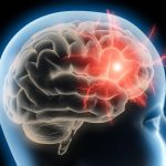 Una lesión cerebral leve podría ser suficiente para desarrollar enfermedad de Parkinson