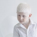 Día Internacional de Sensibilidad sobre el Albinismo – Veracidad News