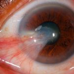 Enfermedades oculares más comunes