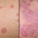 Psoriasis: síntomas y cómo cuidar la piel